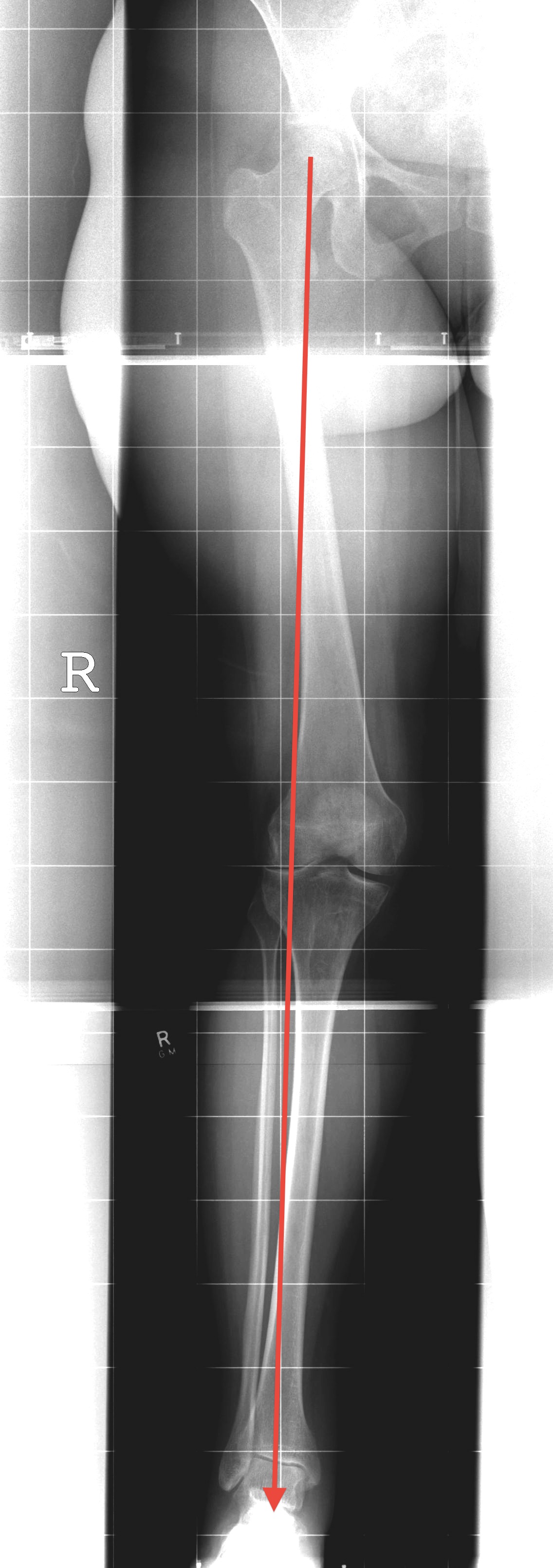 Valgus OA Preop Planning